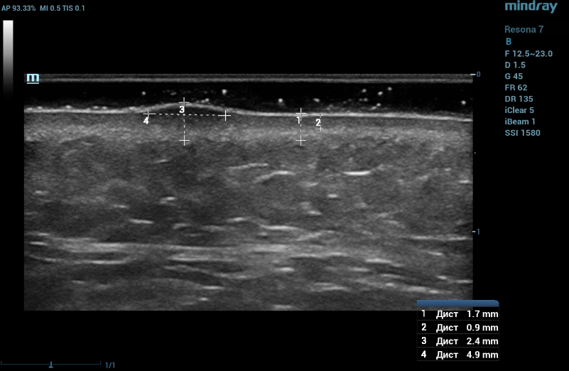 Ultrasound examination of the nevus in B mode