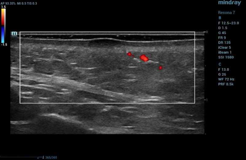 Ultrasound examination of the nevus in Color Doppler mode