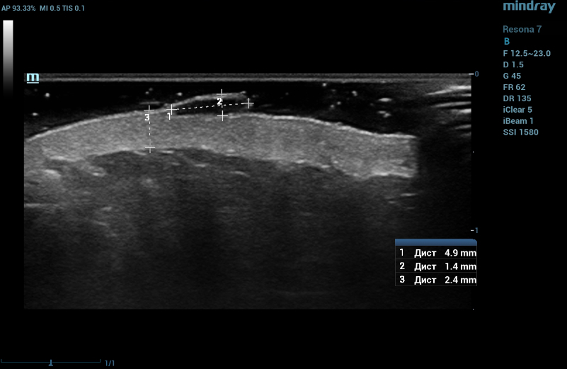 Ultrasound examination of the nevus in B mode. Echo-signs of congenital nevi. The dermis is homogeneous with increased echogenicity