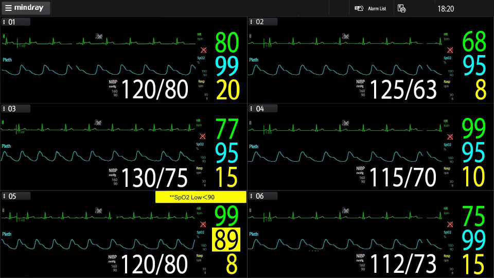 Mindray A7 Anesthesia System Monitor patient vital signs in real-time across all operating rooms