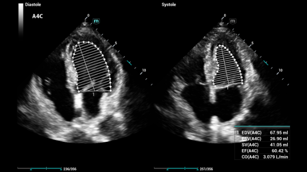 Consona Series Cardiovascular Solution - AutoEF feature clinical image