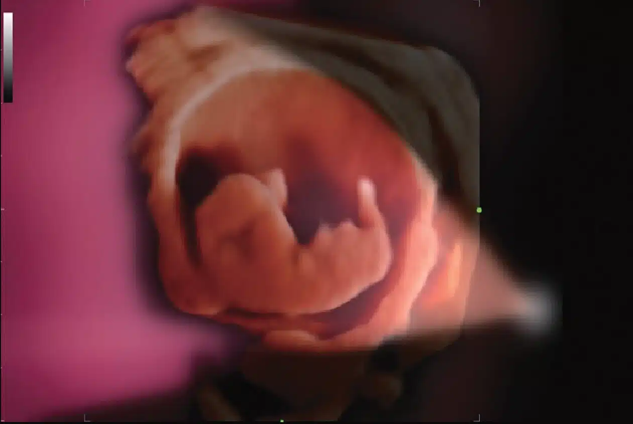 Early-OB-fetus-with-iLive_Imagyn-I9.jpg