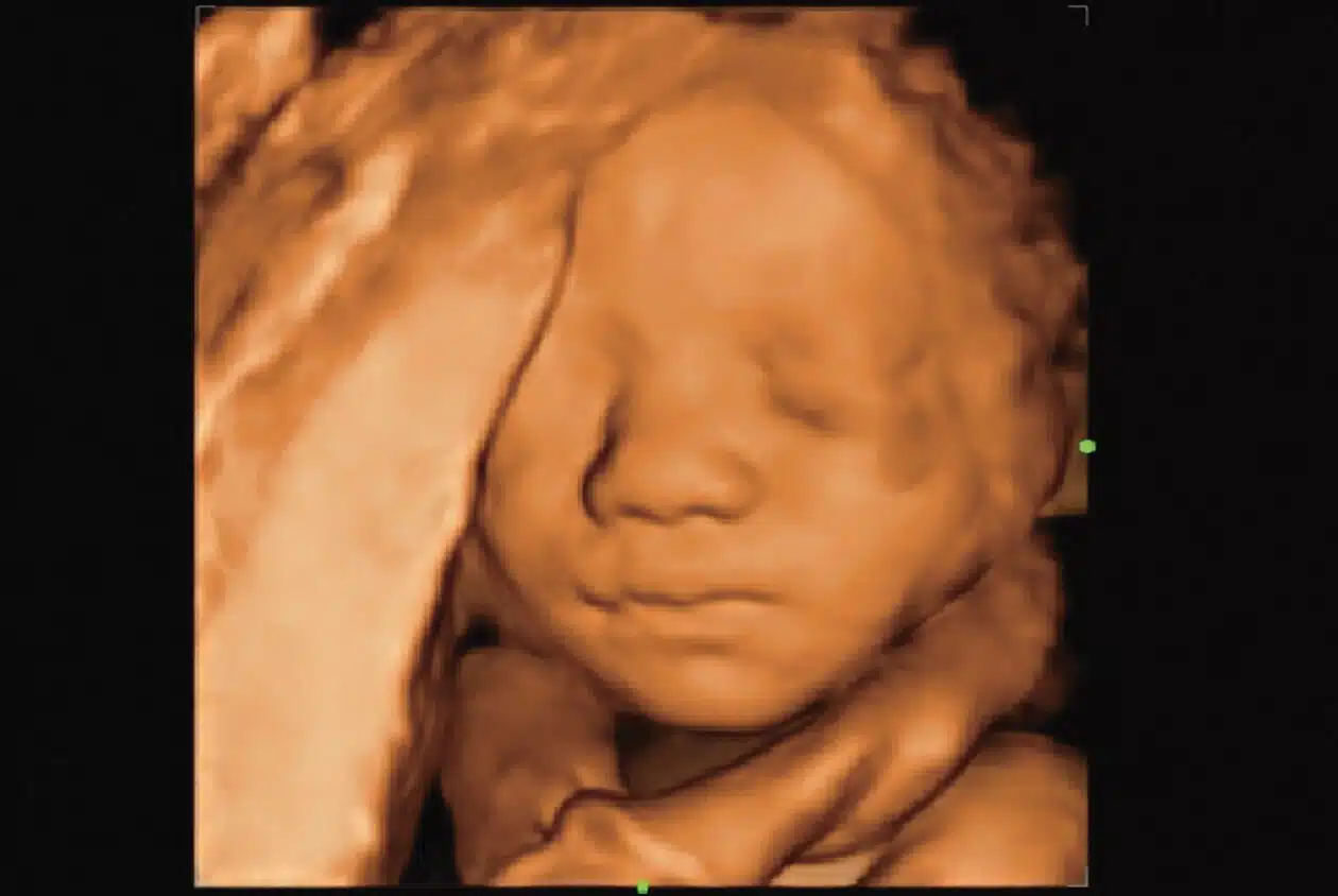 Fetal-Face-3D_Imagyn-I9-1.jpg