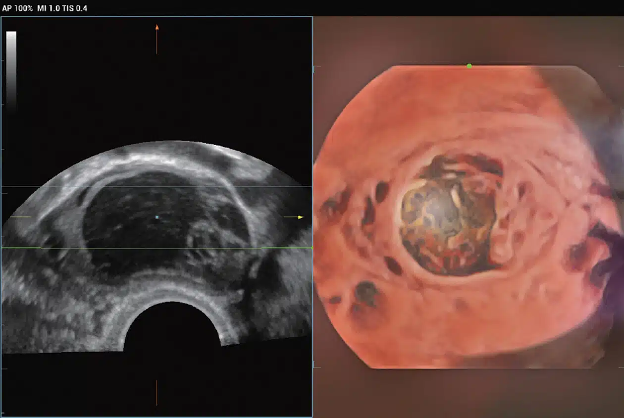 Ovarian-tumor_Imagyn-I9.jpg
