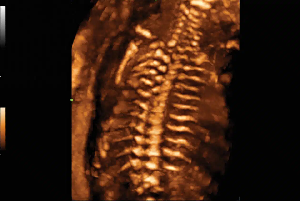 SD8-1s-Fetal-Spine-3D1.jpg