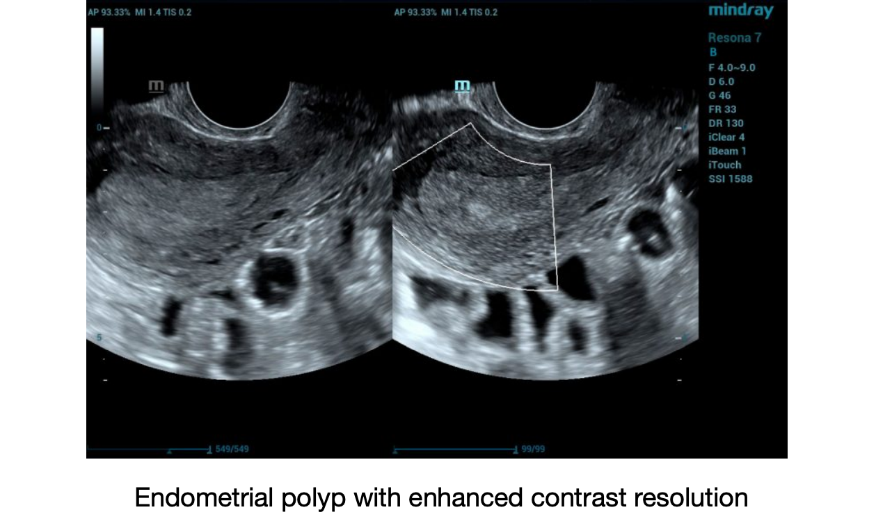 Endometrial polyp with enhanced contrast resolution