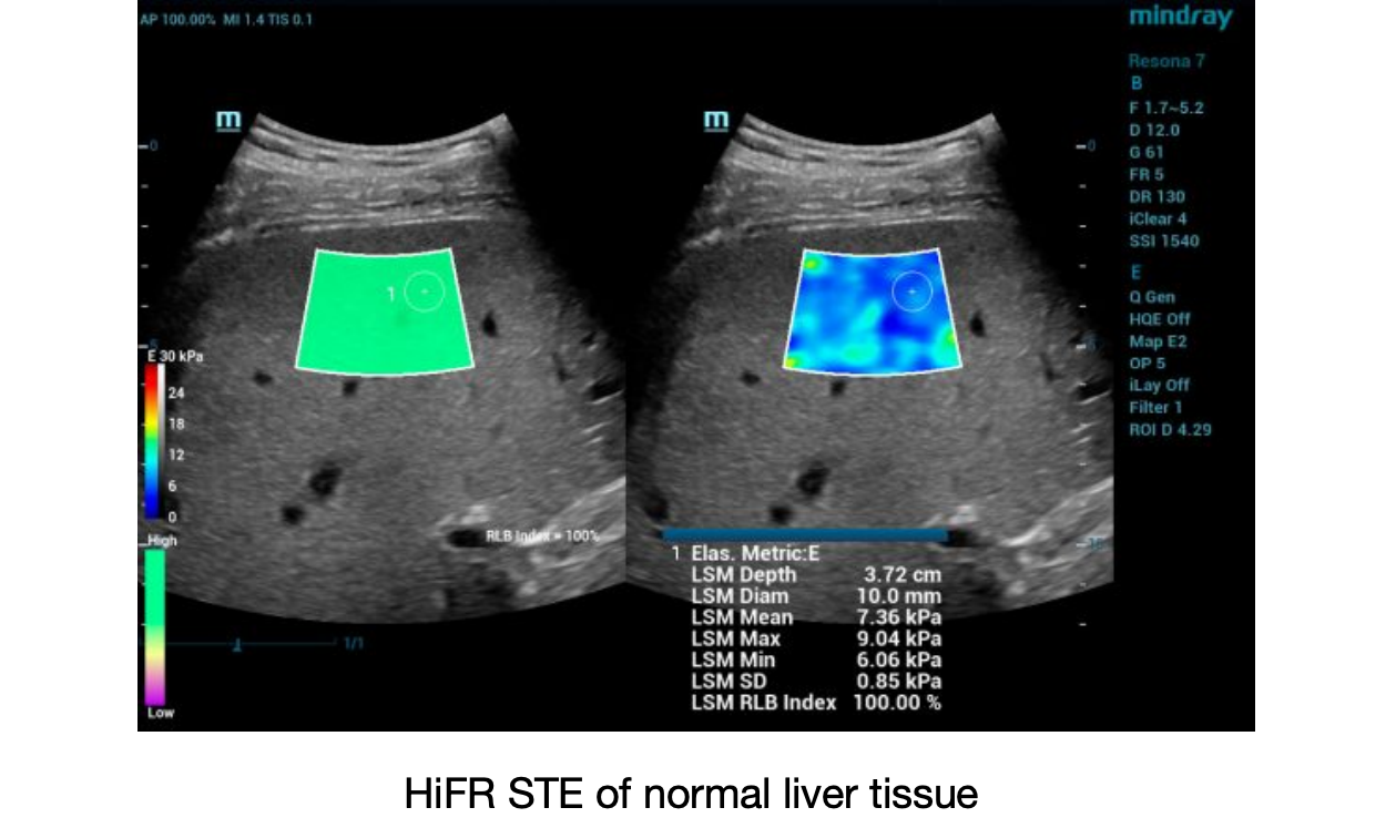 HiFR-STE-of-normal-liver-tissue