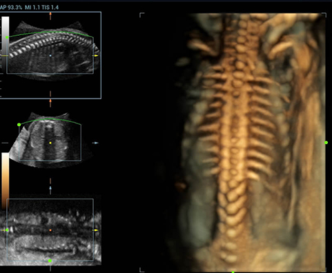 3D Fetal Spine