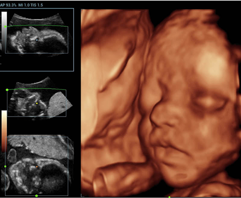3D Fetal Face
