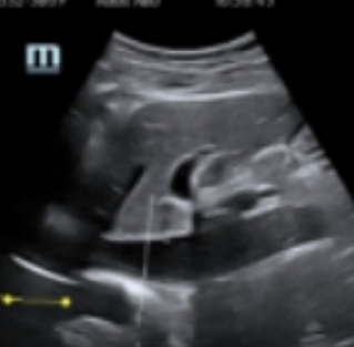 Ultrasound’s Role in the Fight Against COVID-19