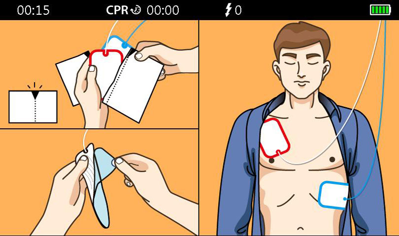 AED pad placement on an Adult