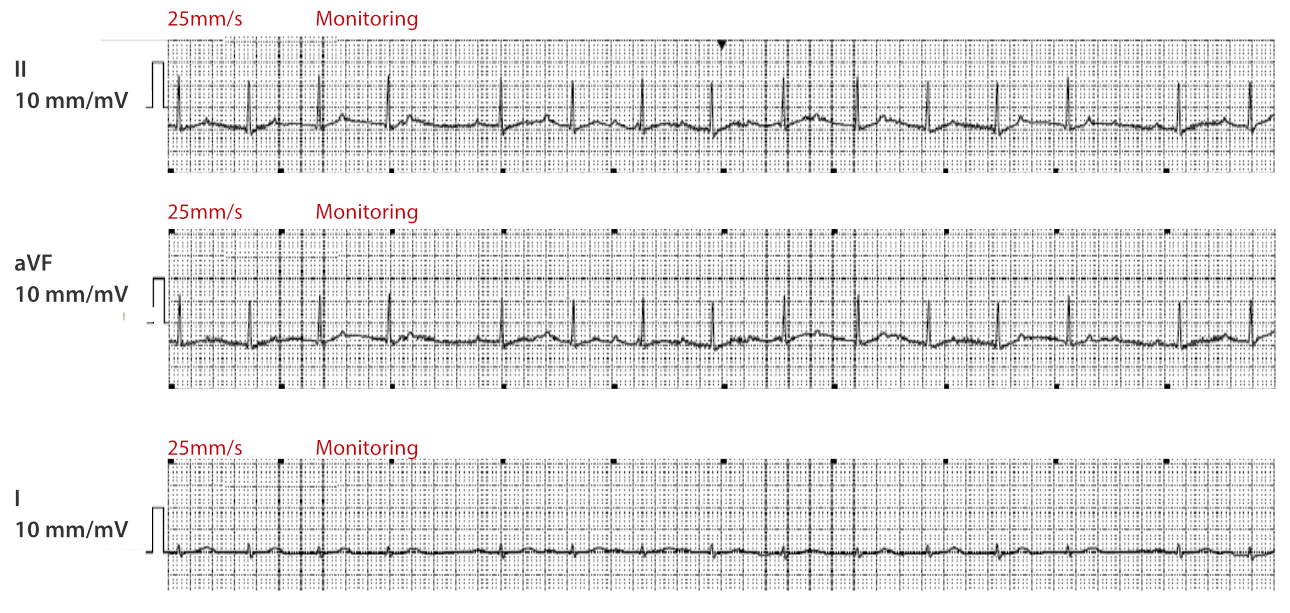 atrial-fibrillation-fig1-pc