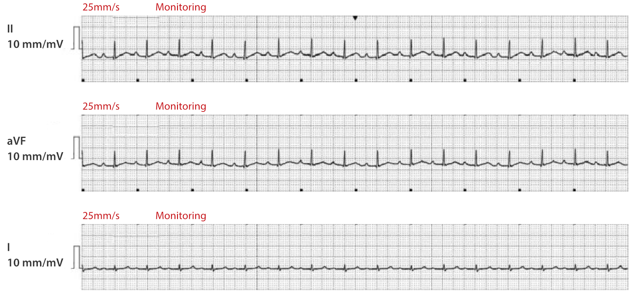 atrial-fibrillation-fig2-pc