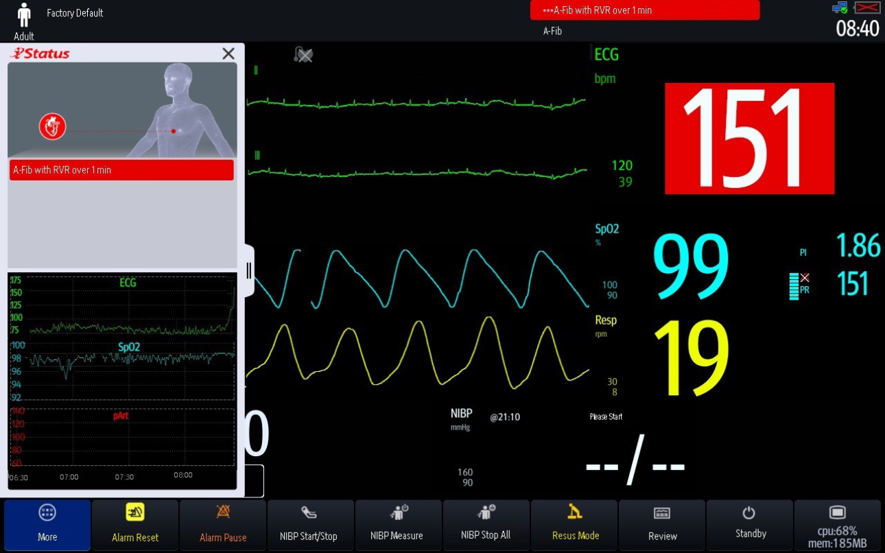 atrial-fibrillation-fig3-pc