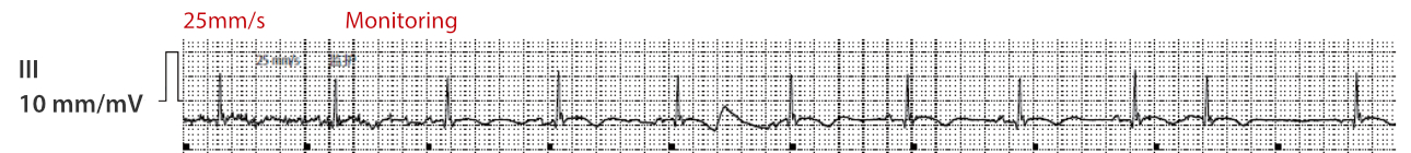 atrial-fibrillation-fig5-pc