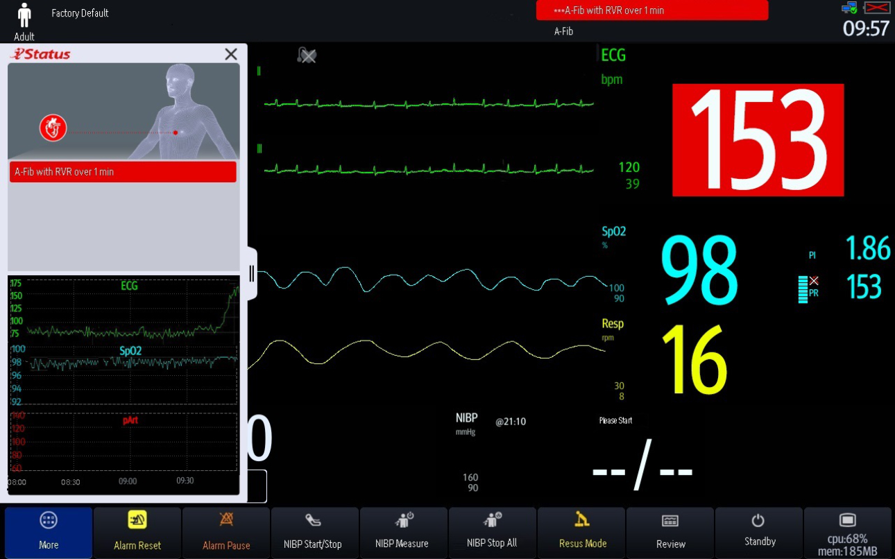 atrial-fibrillation-fig6-pc