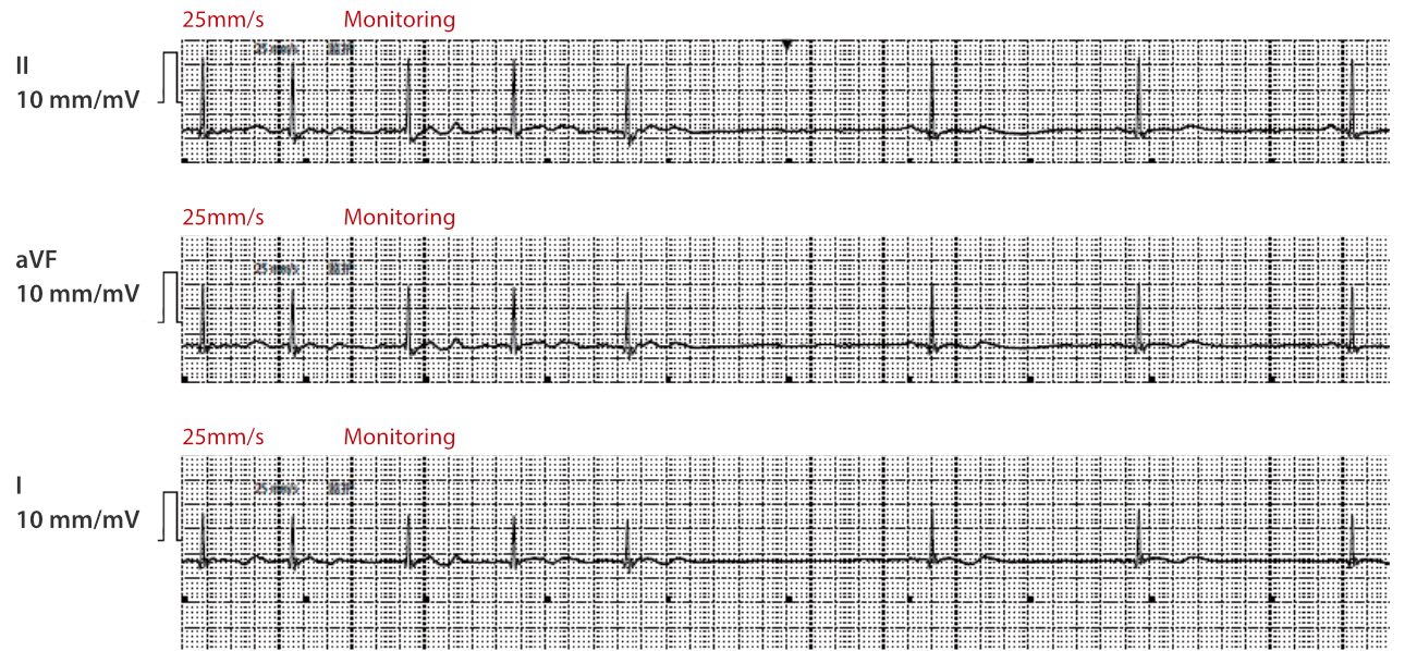 atrial-fibrillation-fig7-pc