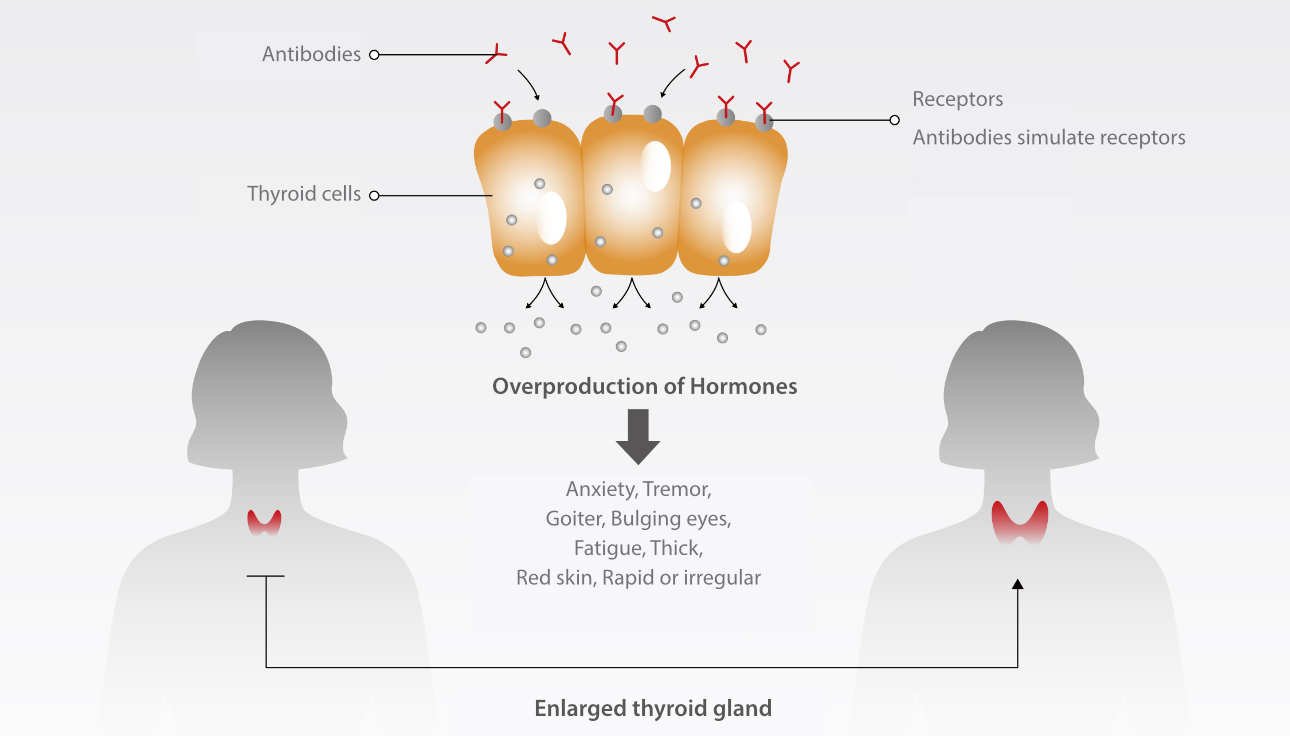 autoimmune-thyroid-fig1-pc