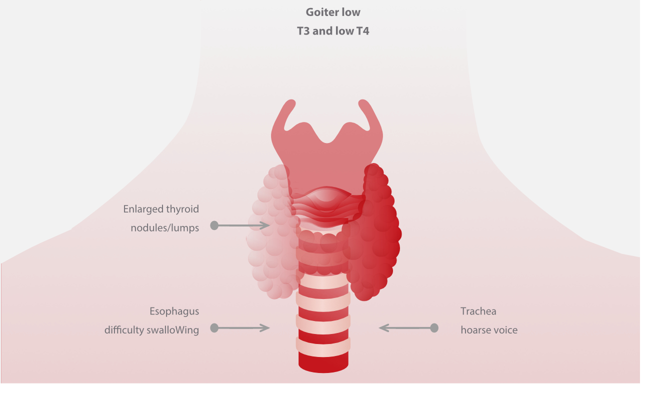 autoimmune-thyroid-fig10-pc