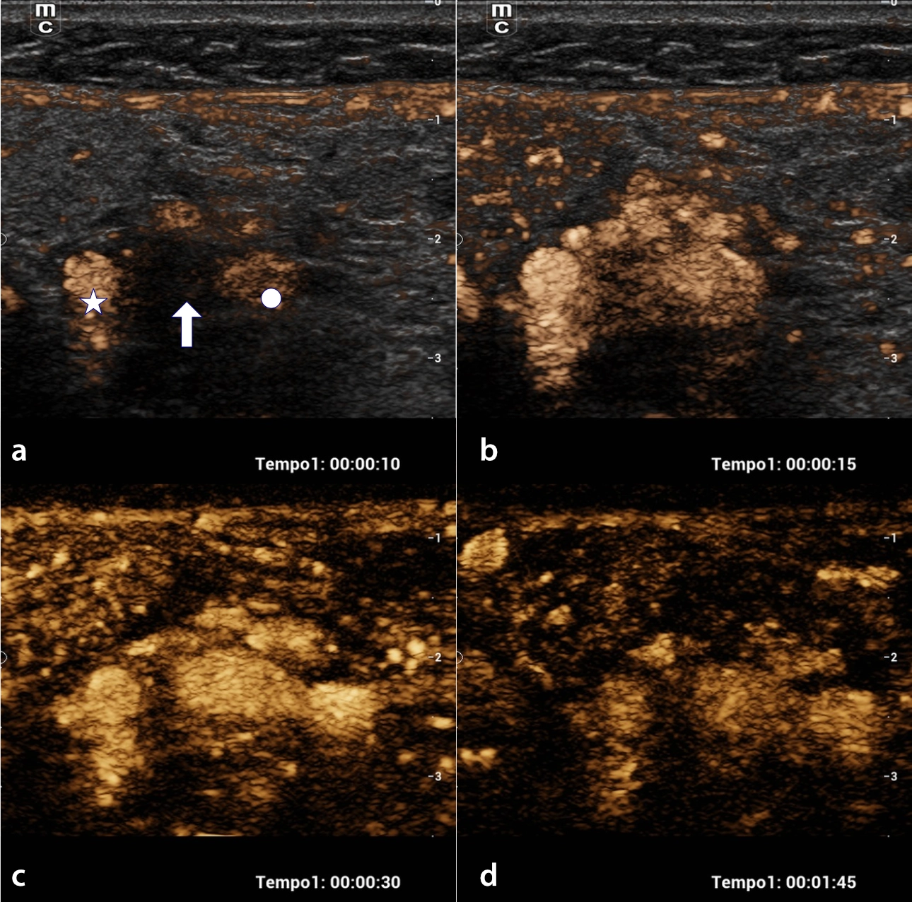 carotid-glomus-fig3-pc