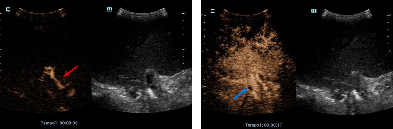 CEUS, an earlier than expected enhancement of vascular structures is observed, the artery phase begins at 8 seconds (red arrow) and the portal/venous phase at 17 seconds (blue arrow).