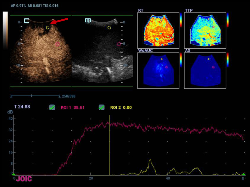 Hypoperfusion zone in segment 8/7 in wedge morphology (red arrow), in the perfusion curves the ROI located in that segment does not show an enhancement of
