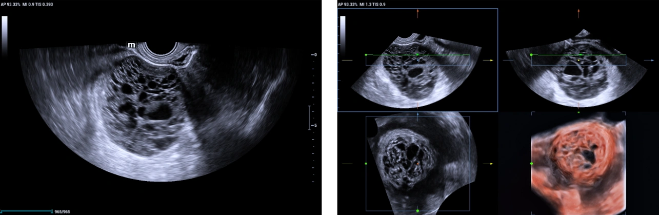 Ultrasound Journal 35 - Use of IOTA - Adnex & O-RADS risk assessment models in MDT management of Adult Granulosa Cell Tumor