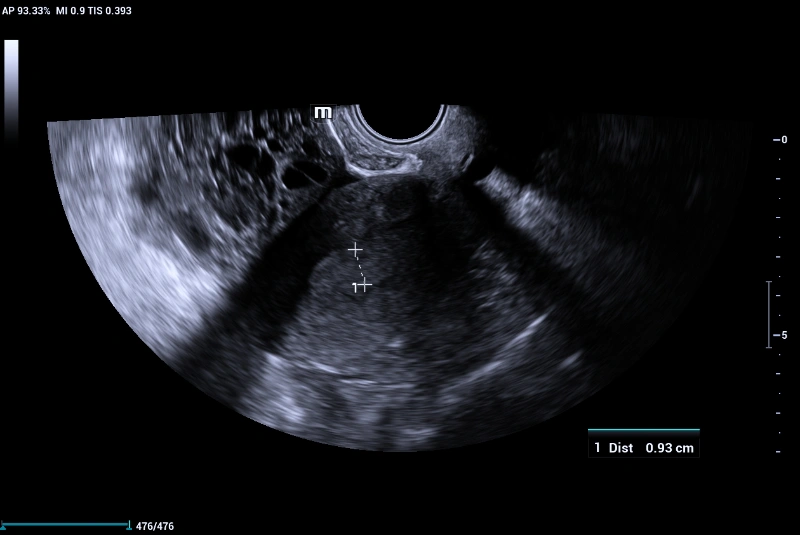 Ultrasound Journal 35 - Use of IOTA - Adnex & O-RADS risk assessment models in MDT management of Adult Granulosa Cell Tumor
