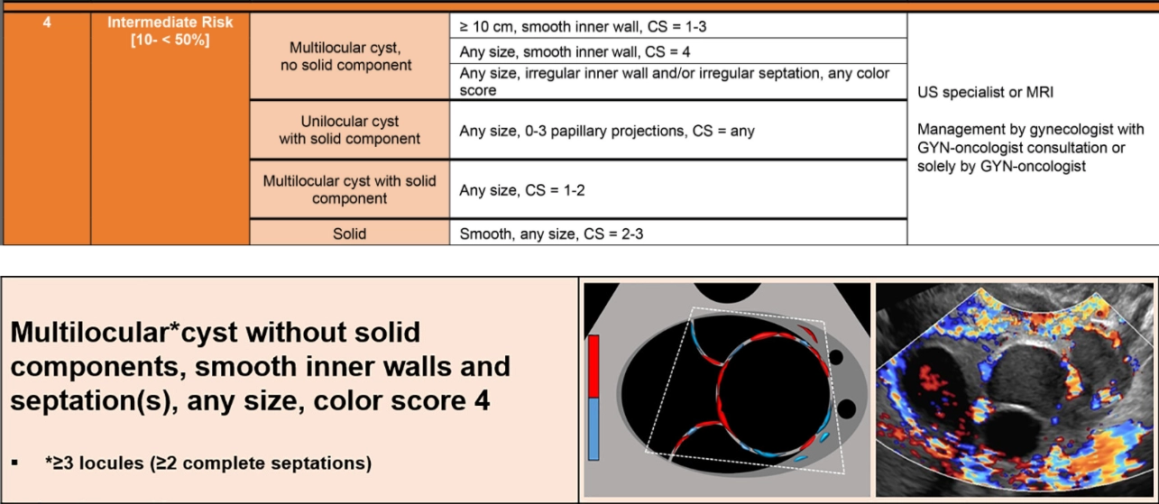Ultrasound Journal 35 - Use of IOTA - Adnex & O-RADS risk assessment models in MDT management of Adult Granulosa Cell Tumor