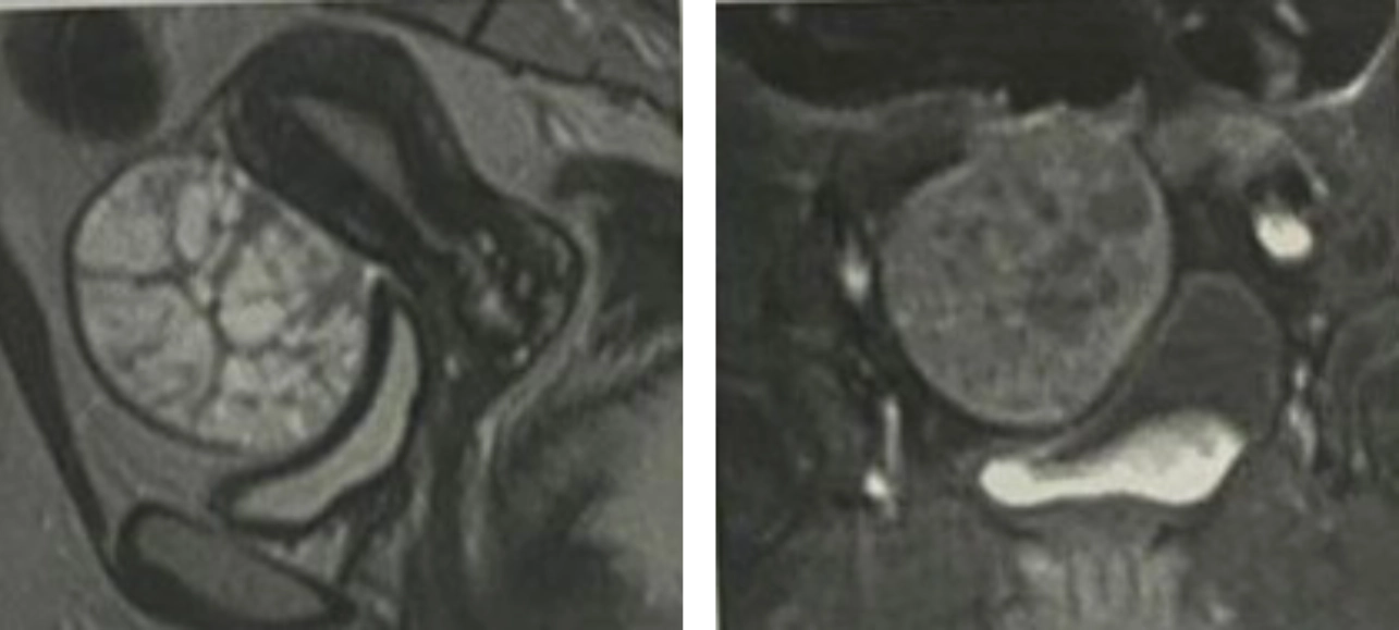 Ultrasound Journal 35 - Use of IOTA - Adnex & O-RADS risk assessment models in MDT management of Adult Granulosa Cell Tumor