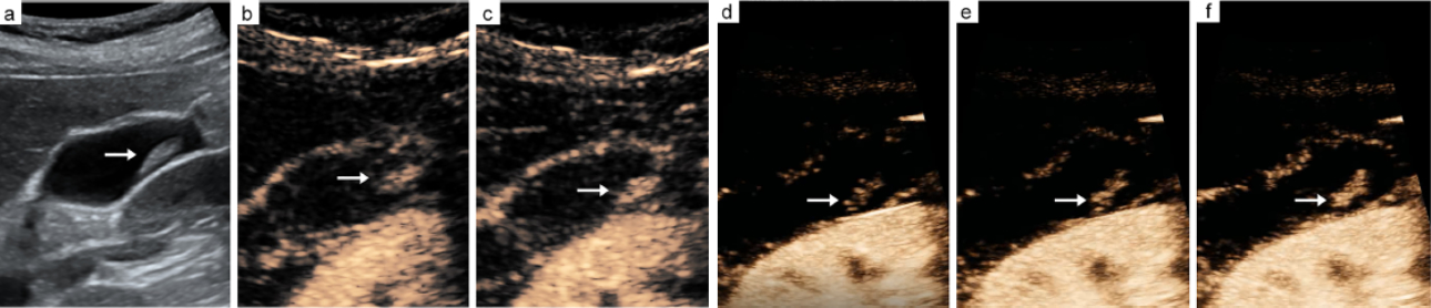 ceus-gallbladder-adenoma-fig1-pc