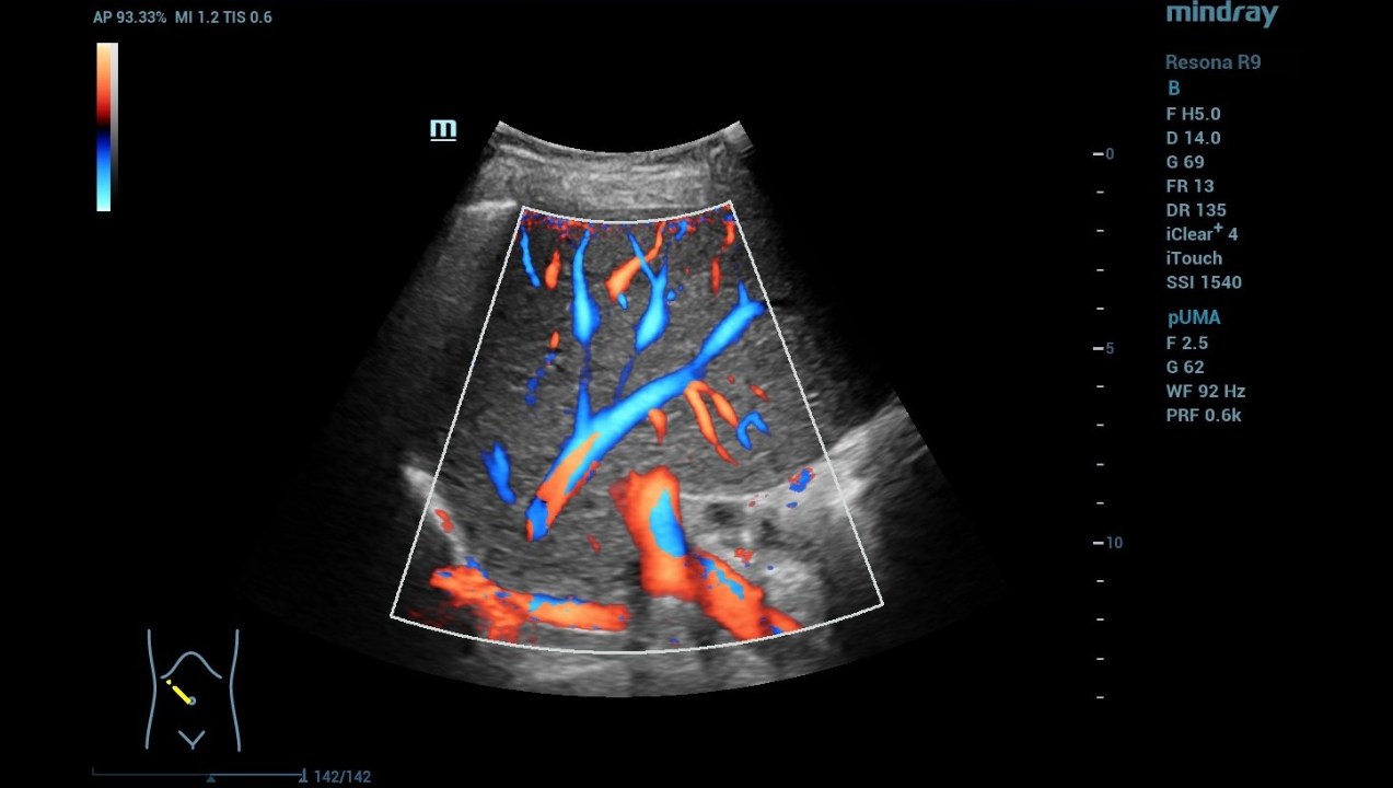 hifr-ceus-liver-fig5-pc