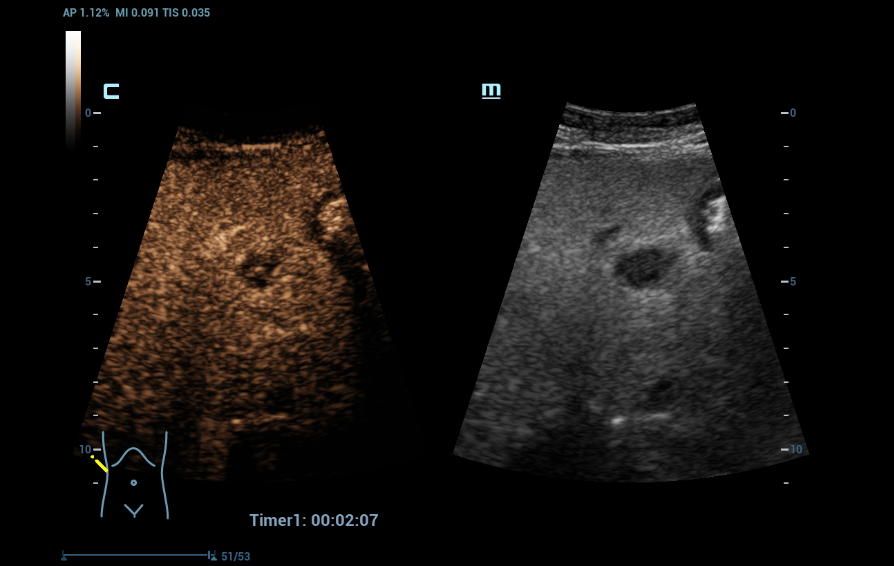 Expert Insights A Closer Look at HiFR CEUS in Liver Diagnosis
