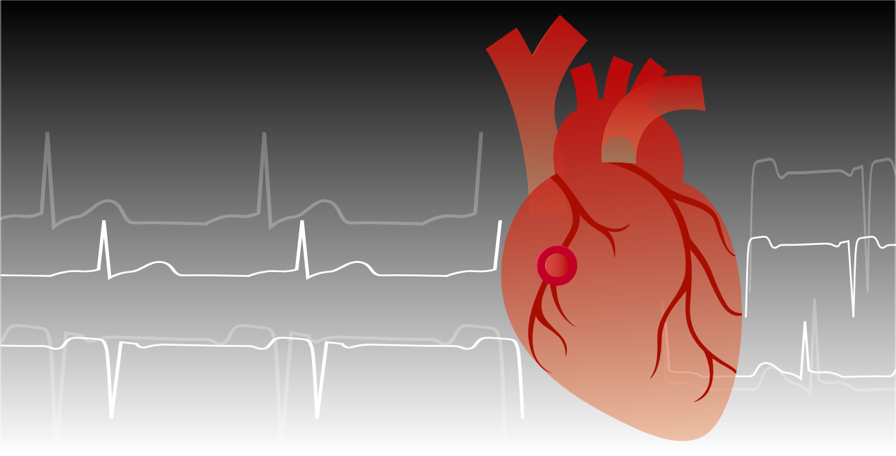 hs-cTnl: Empowering Heart Risk Assessment