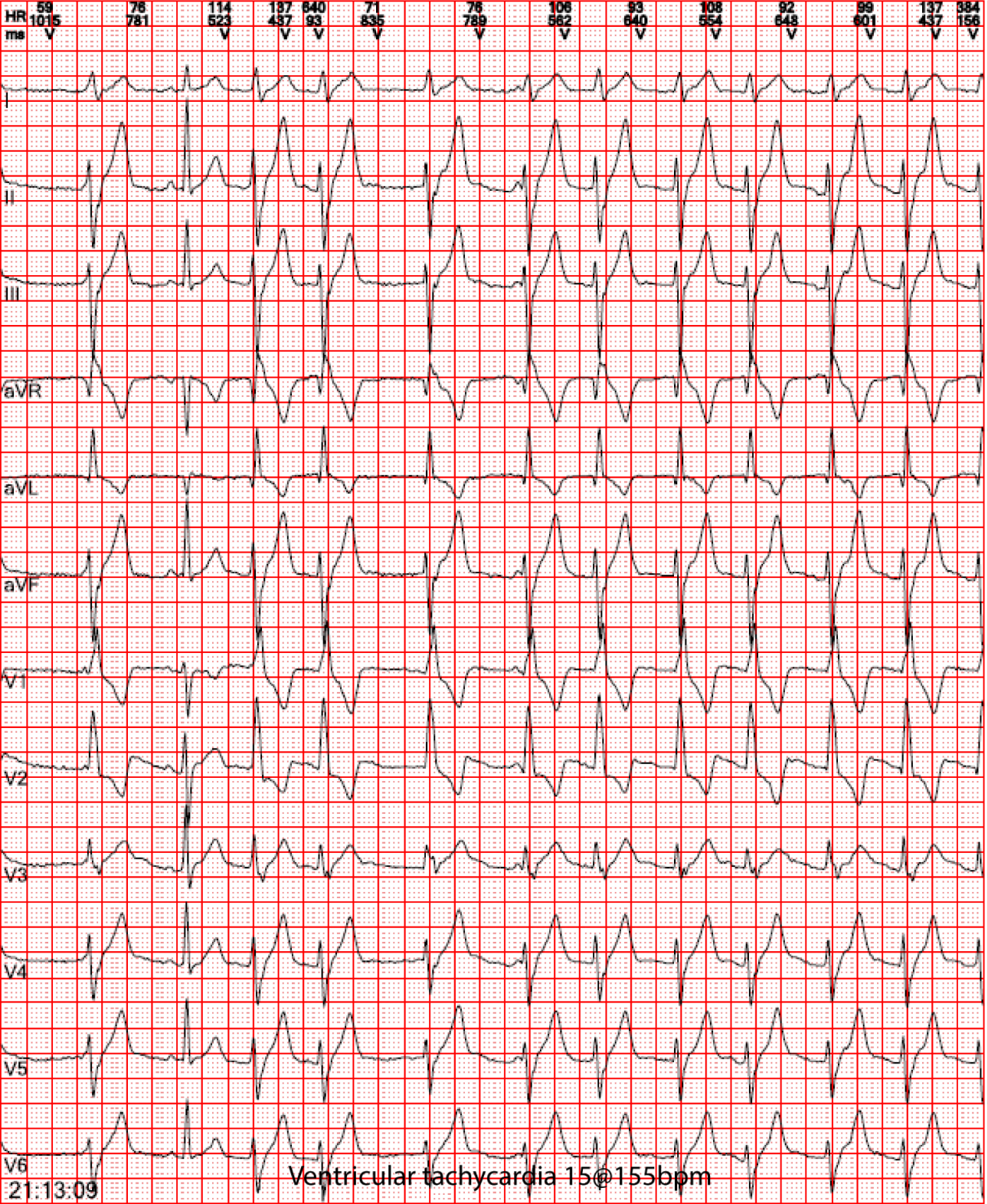 intuitive-ecg-fig1-pc