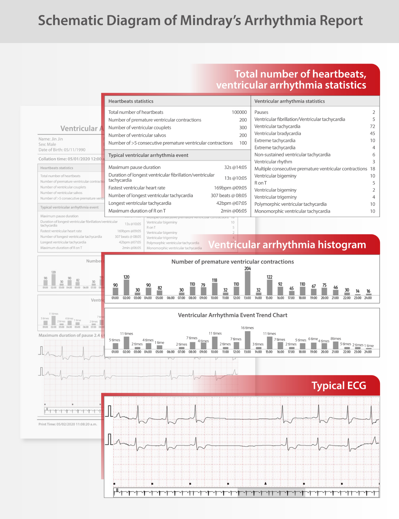 intuitive-ecg-fig6-pc