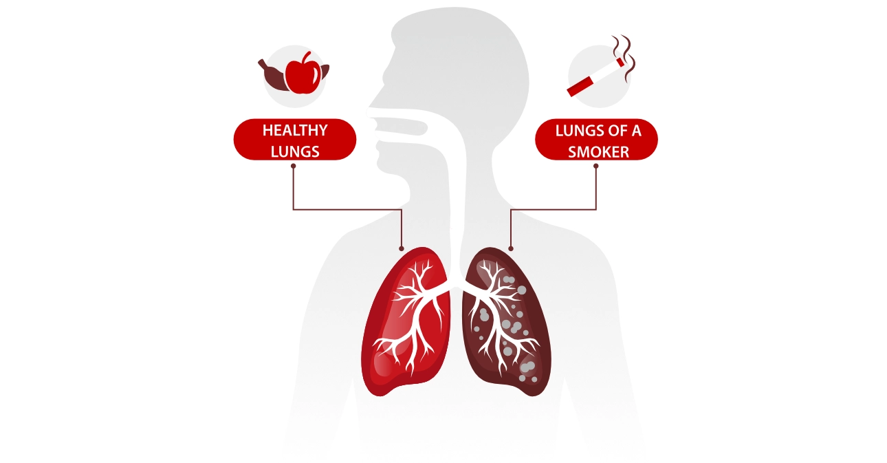 lung-cancer-day-23-fig1-pc