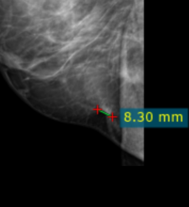 multiparametric-breast-mass-fig1-b