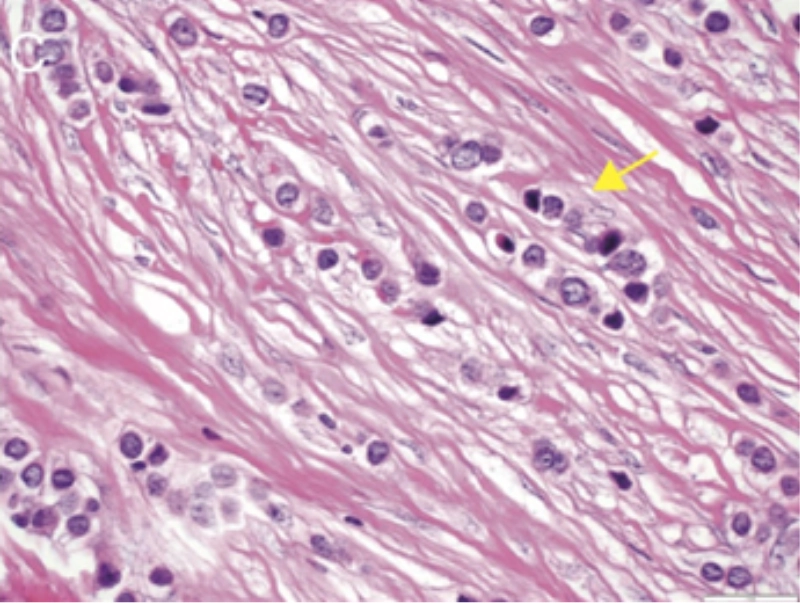 multiparametric-breast-mass-fig7