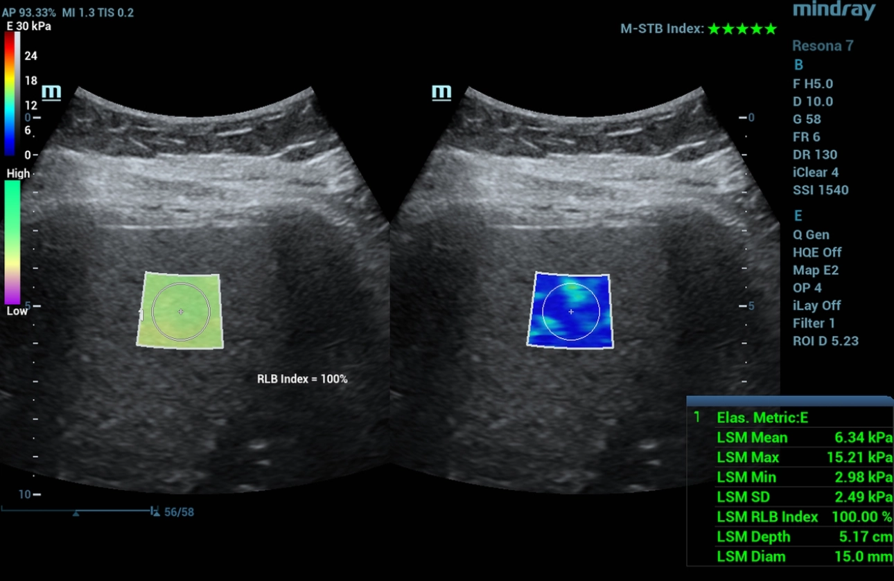 multiparametric-ultrasound-diagnosis-mafl-disease-fig1-pc