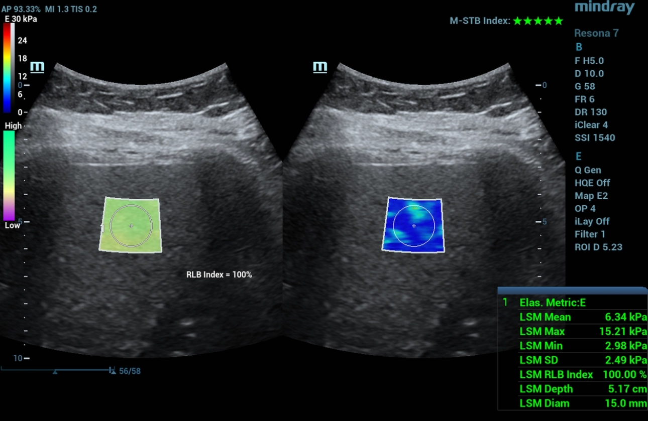 Figure 1. Two-dimensional shear wave elastography (2D-SWE, STE) ultrasound image of the liver: liver parenchyma stiffness 6.34 kPa (F0-F1 - clinically insignificant liver fibrosis).