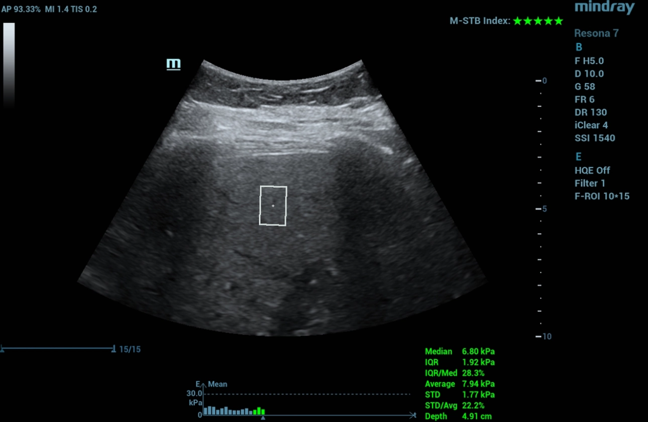 multiparametric-ultrasound-diagnosis-mafl-disease-fig2-pc