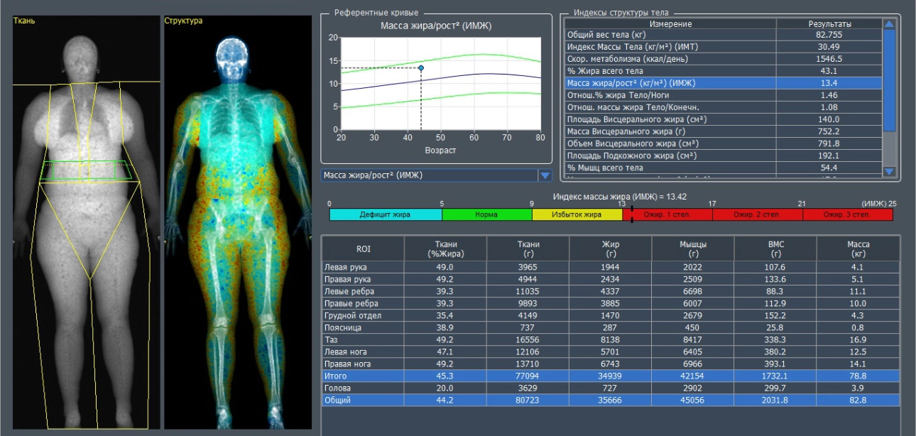 Figure 3. Dual-energy X-ray absorptiometry (DEXA) in “Whole-body” mode: percentage of adipose tissue 43.1%, fat mass index 13.42 (grade I obesity), visceral fat area 140 cm2.