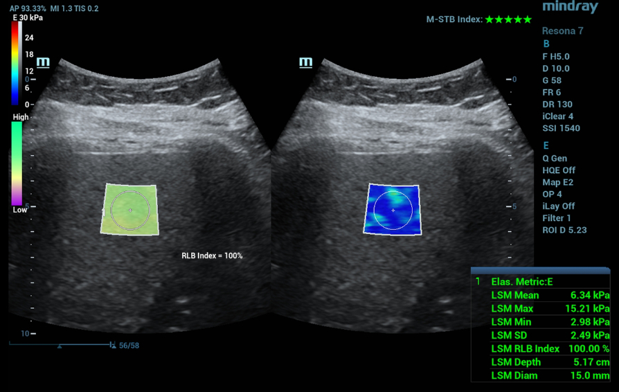 multiparametric-ultrasound-diagnosis-mafl-disease-kv-pc