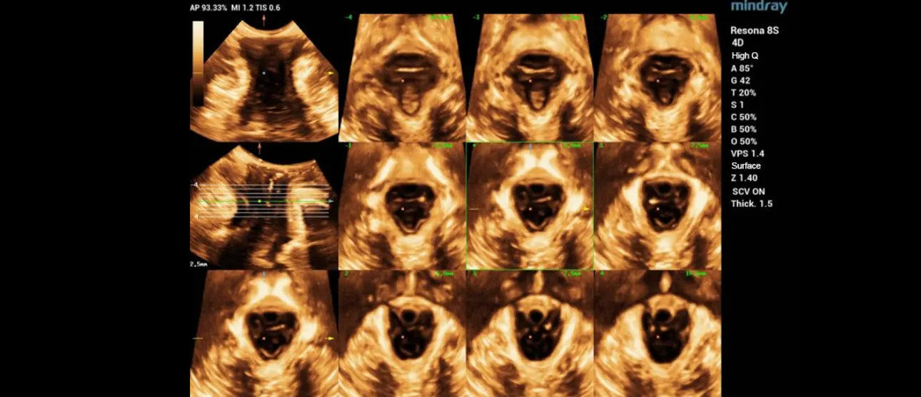 pelvic-floor-dysfunction-fig3-pc