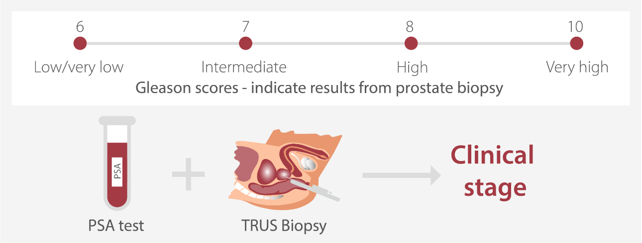 prostate-cancer-psa-fig12-pc