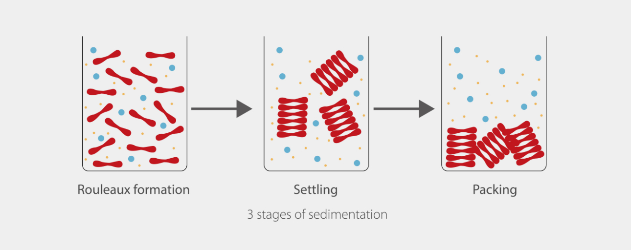 What is the erythrocyte sedimentation rate (ESR)? • The Blood Project