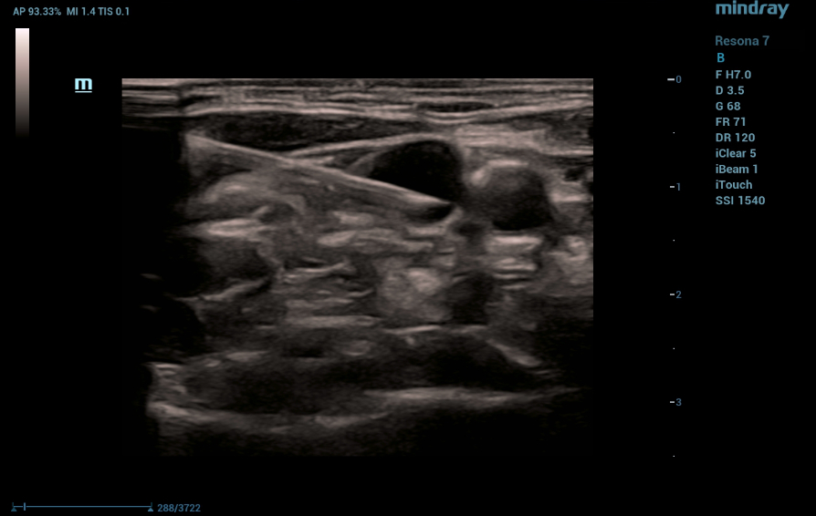 subcutaneous-venous-port-kv-pc