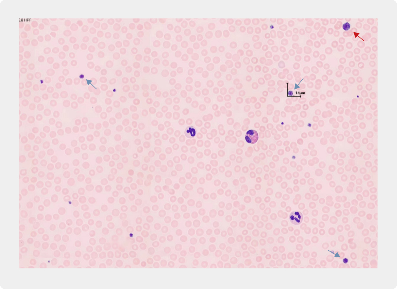 thrombocytopenia-smear-fig4-pc