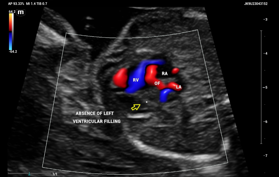 Detection of Hypoplastic Left Ventricular Syndrome in Second-Trimester Ultrasound Screening key visual banner